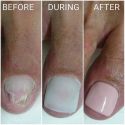 Гель для протезирования ногтей с антимикозным эффектом